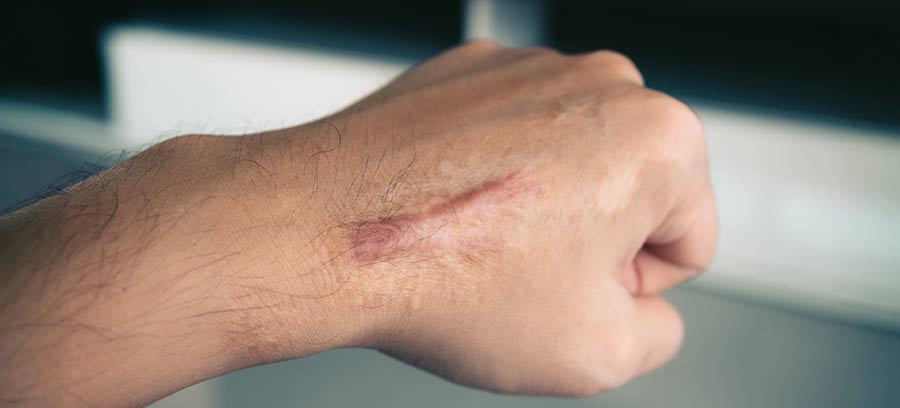 Scar Removal Treatment in Kolkata | Dr. Surabhi Sharma 